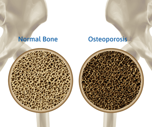 Osteoporosis Bone Loss